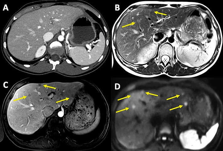 Figure 2 : Scanner et IRM hépatique dans le cadre du bilan d’extension d’une TNEG