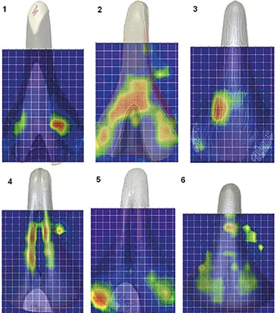
Figure 5 : comparaison des pressions en fonction de 2 formes de selles (56)