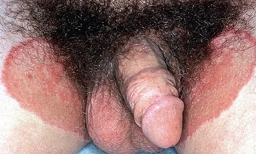 Figure 7 : intertrigo inguino-scrotal (64)