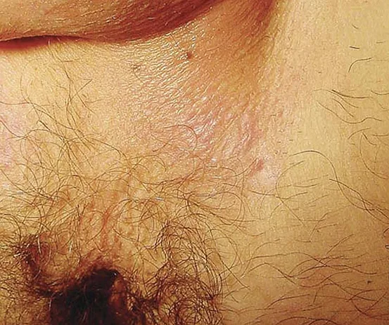 Figure 8 : « acné mécanique » (65)