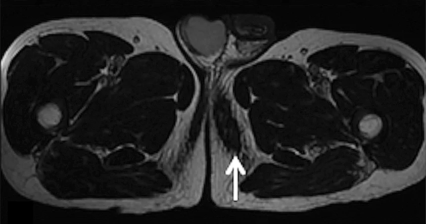 Figure 10 : aspect IRM axiale en T2 d’un « 3e testicule » chez un cycliste (69) (flèche)