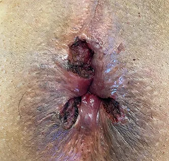 Photo 3 : Vue post-opératoire de la chirurgie selon Milligan et Morgan