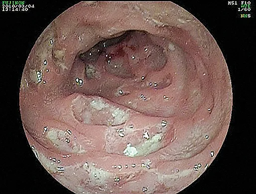 Figure 3 : Lymphogranulomatose vénérienne rectale (Coll. Élise Pommaret)