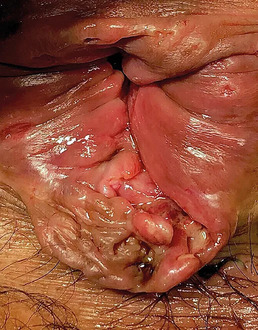 Figure 4 : Ano-rectite à Monkeypox (Coll. Amélie Barré)