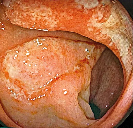 Figure 5 : Ulcère solitaire du rectum
(Coll. Anne Laure Rentien)