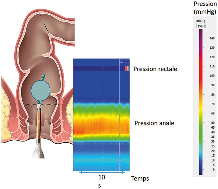 Figure 1 : Manométrie anorectale haute-résolution