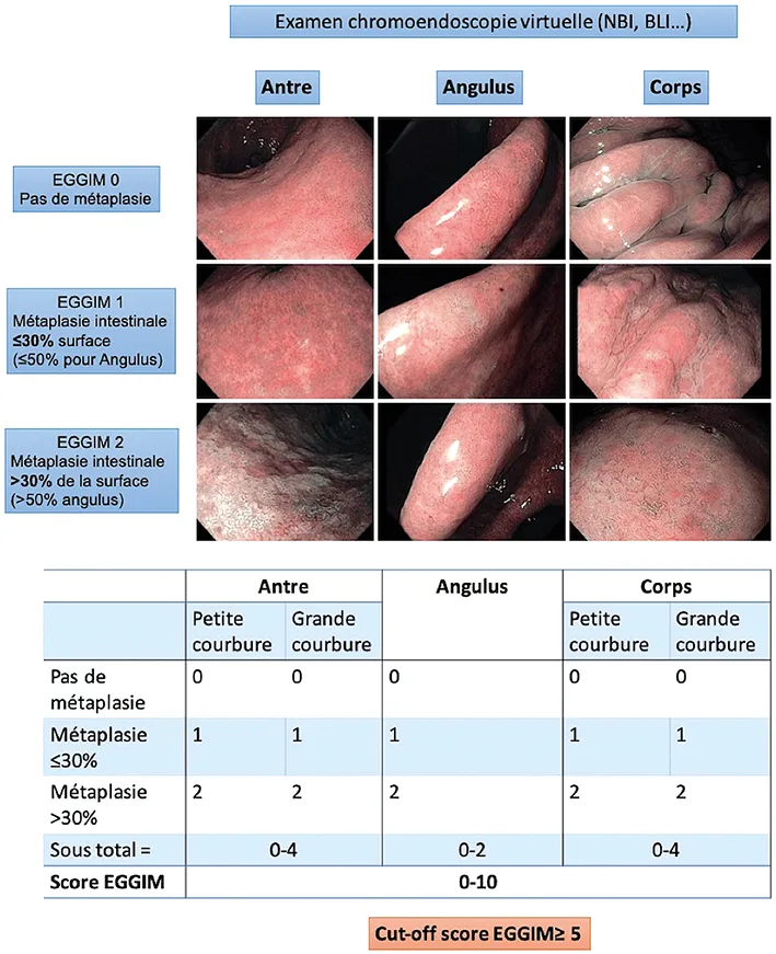 Figure 4 : Score EGGIM, adapté de Esposito et al. Endoscopy 2018 (14)