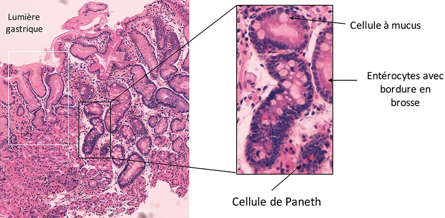 Figure 6 : Diagnostic anatomopathologique de métaplasie intestinale complète