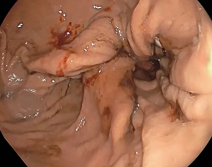 Figure 1 : Résultat final d’une endosleeve Gastroplastie.
La lumière du corps gastrique est visiblement réduite