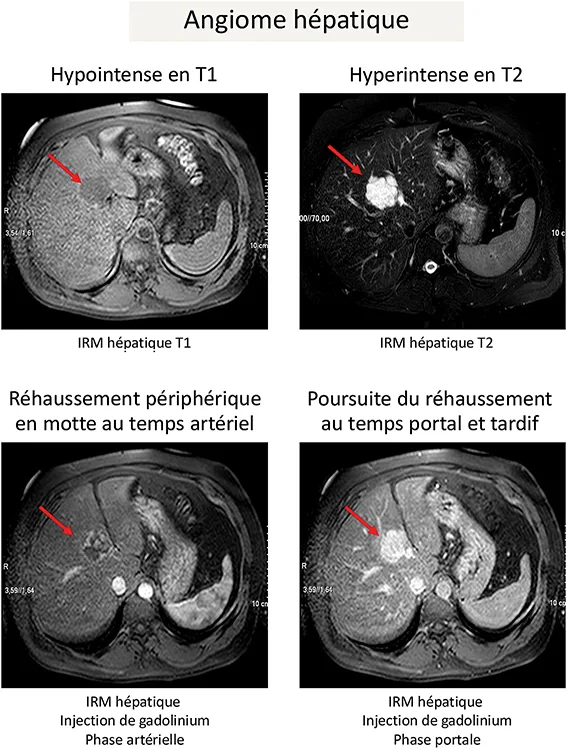 Figure 1 : Caractéristiques à l’imagerie (IRM hépatique avec injection de Gadolinium) d’un hémangiome hépatique