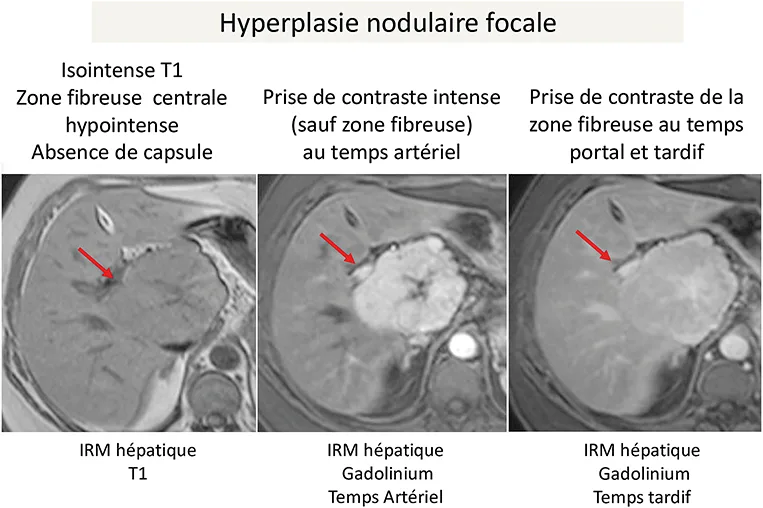 Figure 2 : Caractéristiques à l’imagerie (IRM hépatique avec injection de Gadolinium) d’une hyperplasie nodulaire focale