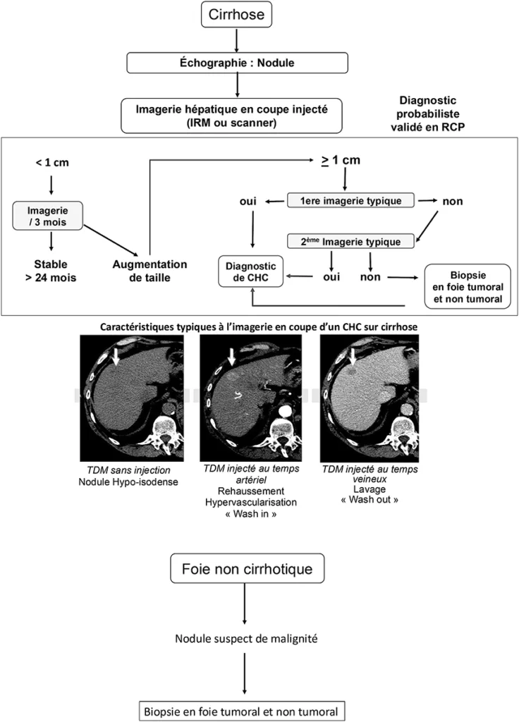Figure 4 : algorithme diagnostic du carcinome hépatocellulaire sur foie cirrhotique et non cirrhotique