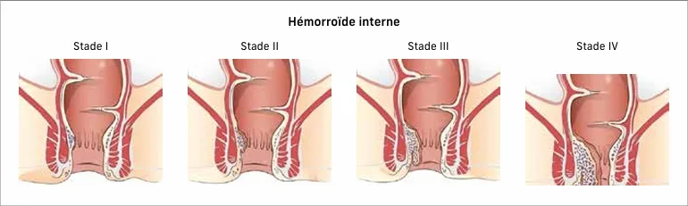 Figure 1 : introduction : stade hémorroïdaire selon la classification de Goligher