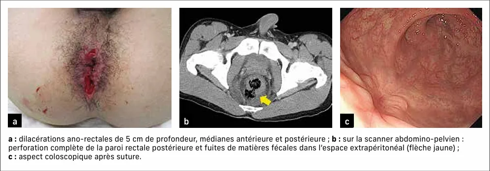 Figure 16 : perforation ano-rectale lors d’un accident de jet-ski (83)