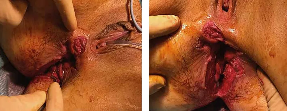 Figure 17 : vue per-opératoire d’une plaie périnéale postérieure chez une patiente de 19 ans suite à une chute en jet-ski (84)