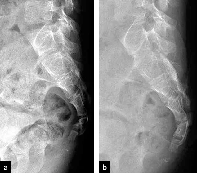 Figure 18 : fracture sacro-coccygienne (91)