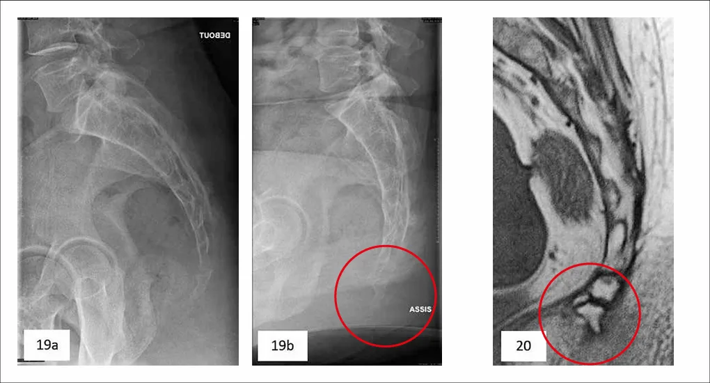 Figures 19a, 19b et 20 : luxation postérieure du coccyx [19a et 19b] (© Coll JM Didelot) et épine coccygienne [20] (92)
