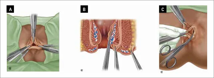 Figure 2 : Technique de l’hémorroïdectomie pédiculaire selon Milligan et Morgan [d’après Moult et al. (49)]