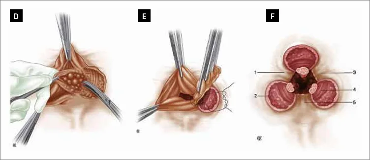 Figure 2 bis : Schéma de la technique de l'hémorroïdectomie pédiculaire selon Milligan et Morgan