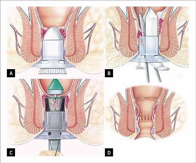 Figure 3 : Technique d’anopexie par agrafage circulaire selon Longo
(schémas du laboratoire Ethicon Endosurgery®)