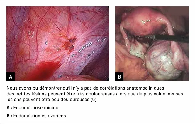 Figure 4 : exemple de deux lésions différentes d’endométriose