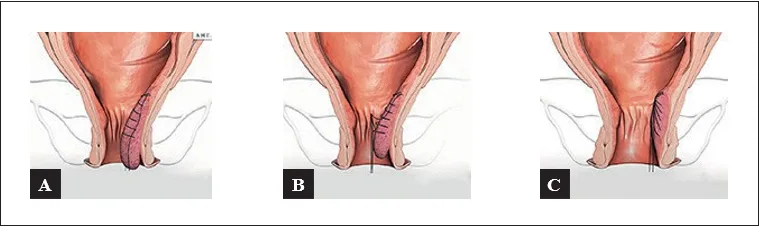 Figure 4b : Technique de mucopexie (schémas du laboratoire AMI©)