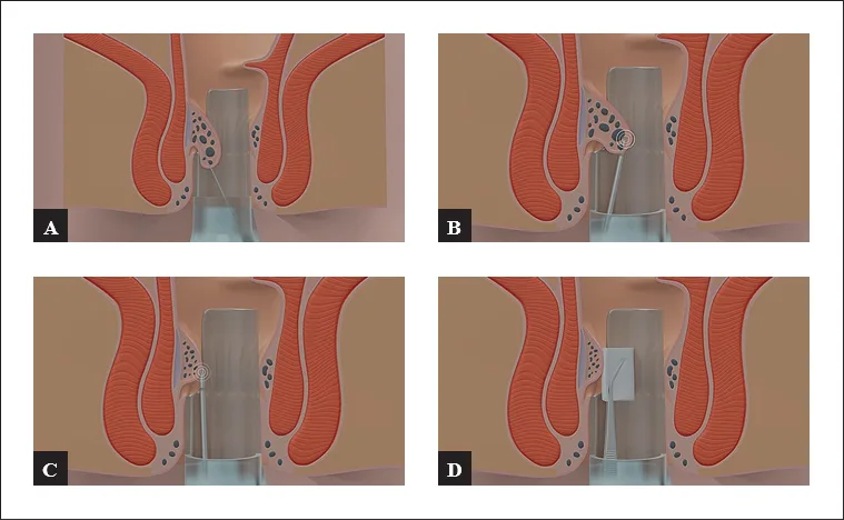Figure 5 : Schéma sur technique de thermocoagulation hémorroïdaire interne par radiofréquence (schéma du laboratoire laboratoire FCare Systems©)