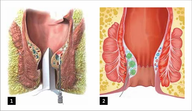 Figure 6 : Schéma sur la technique d’hémorroïdoplastie laser
1) schéma du laboratoire DUOMED® ; 2) d’après LHP recommandation group (41)