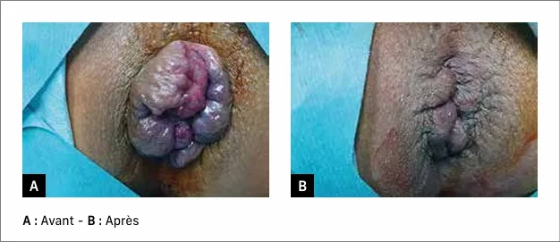 Photo 5 : Photo per opératoire d’une thermocoagulation par radiofréquence
