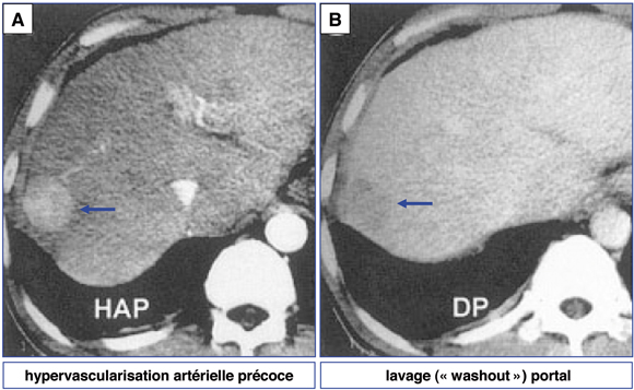 Diagnostic des nodules sur cirrhose. Quelle est la place de la ...