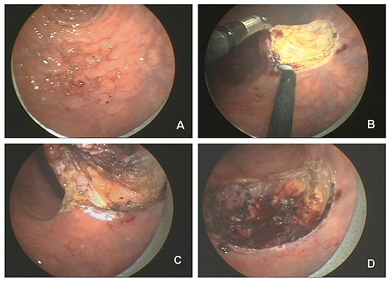 Figure 4 : Vues opératoire au cours d’une TEM. 4A: Distension permanente du rectum permettant de bien visualiser la lésion villeuse. 4B: Début de dissection de la lésion à l’aide de 2 instruments. 4C Résection jusqu’à la graisse péri-rectale. 4D: Cavité de résection après exérèse.