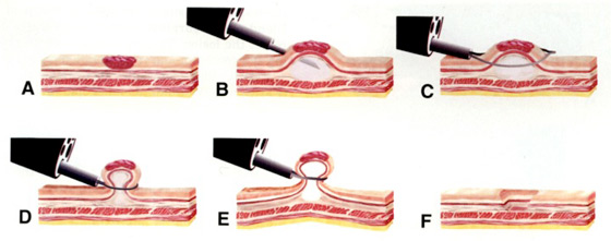 Figure 1 : technique de la mucosectomie