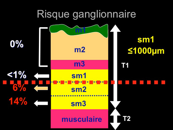 Figure 11 : risque ganglionnaire en fonction de l’invasion en profondeur