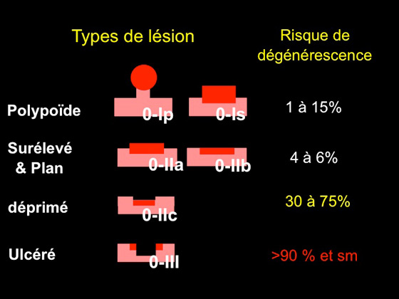 Figure 4 : classification de Paris et risque de dégénérescence