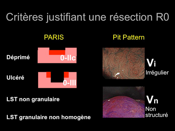 Figure 8 : critères endoscopiques macroscopiques de dégénérescence