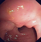 localisation endométriosique du haut rectum