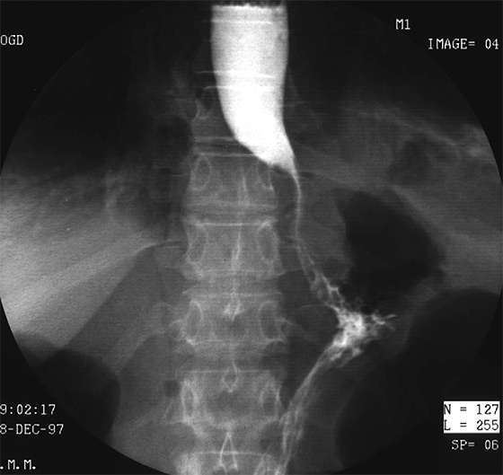 Figure 5. TOGD à J1 post-opératoire. Sténose du bas œsophage.